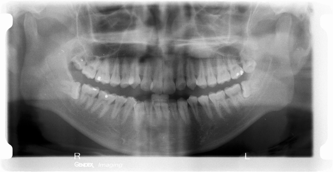En tredimensjonal CBCT-skanning av en kjeve som tydelig viser posisjonen til en impaktert visdomstann.